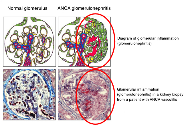 Diagram showing glomerulonephritis- an illustration of a normal glomerulus and one with glomerular inflammation; and a kidney biopsy from a patient with ANCA vasculitis