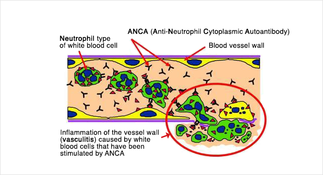 Illustration showing neutrophils, ANCA, and inflammation of the vessel wall caused by white blood cells that have been stimulated by ANCA