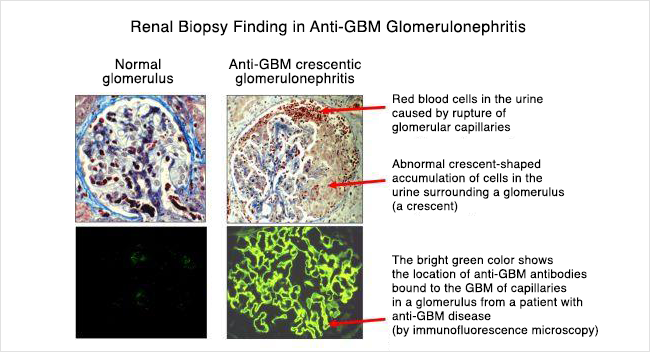 Anti Gbm Disease Unc Kidney Center, Glomerular Basement Membrane Abnormality