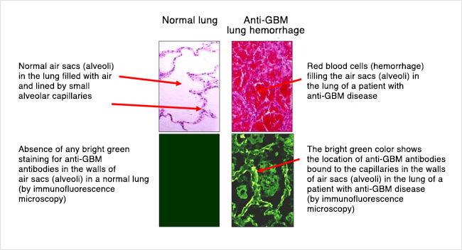 Anti-GBM lung
