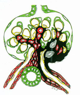 Glomerulus - FSGS - graphic illustration