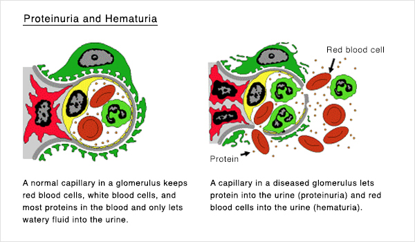 Proteinuria and Hematuria